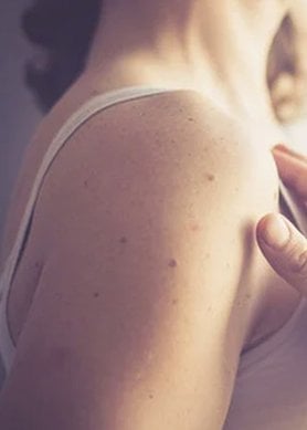 comment-proteger-cicatrice-soleil_1226x680