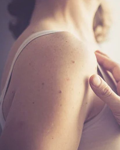 comment-proteger-cicatrice-soleil_1226x680