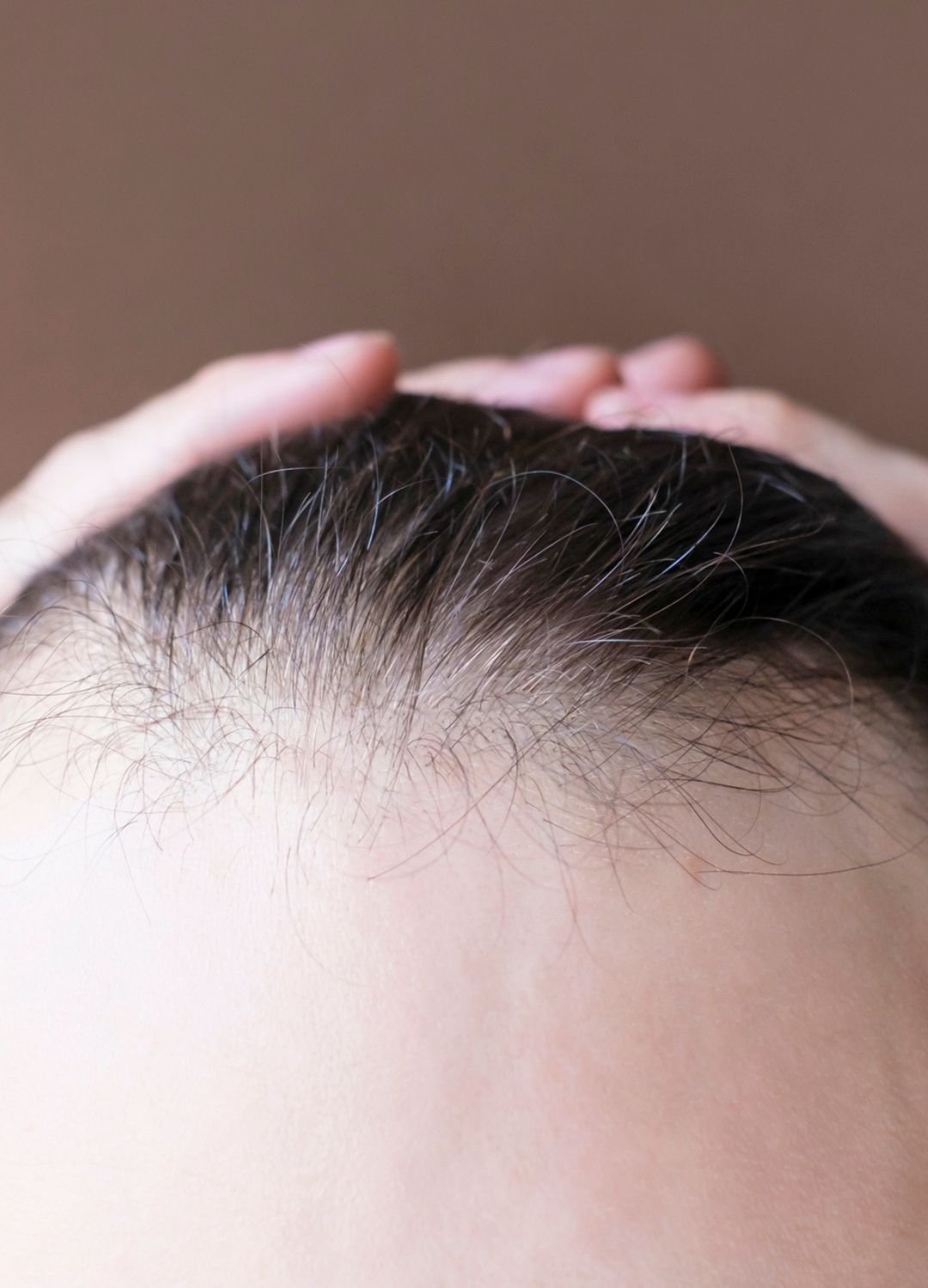 Image d'une personne ayant une alopécie frontale fibrosante