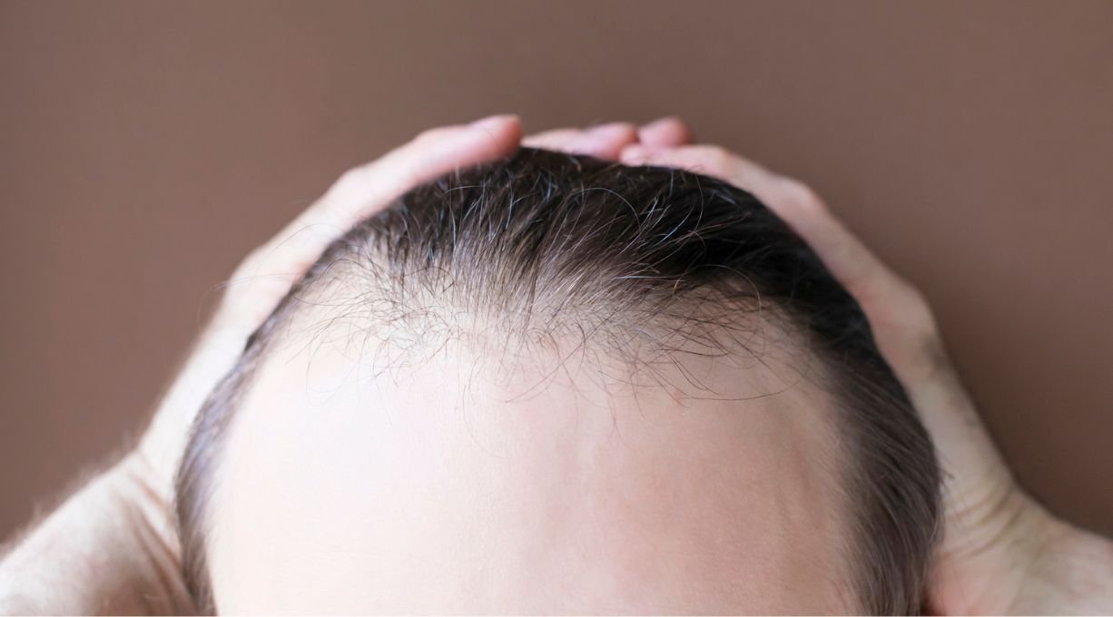 Image d'une personne ayant une alopecie frontale fibrosante