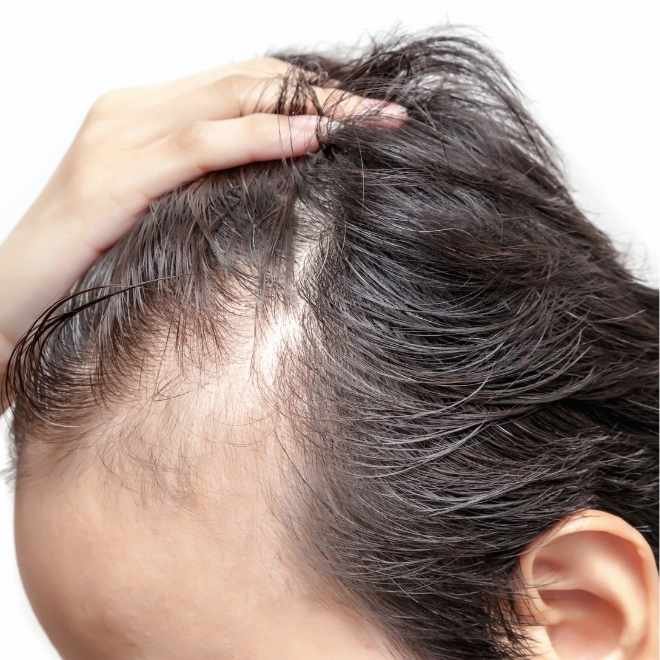 homme montrant le début d'une perte de cheveux sur son crâne