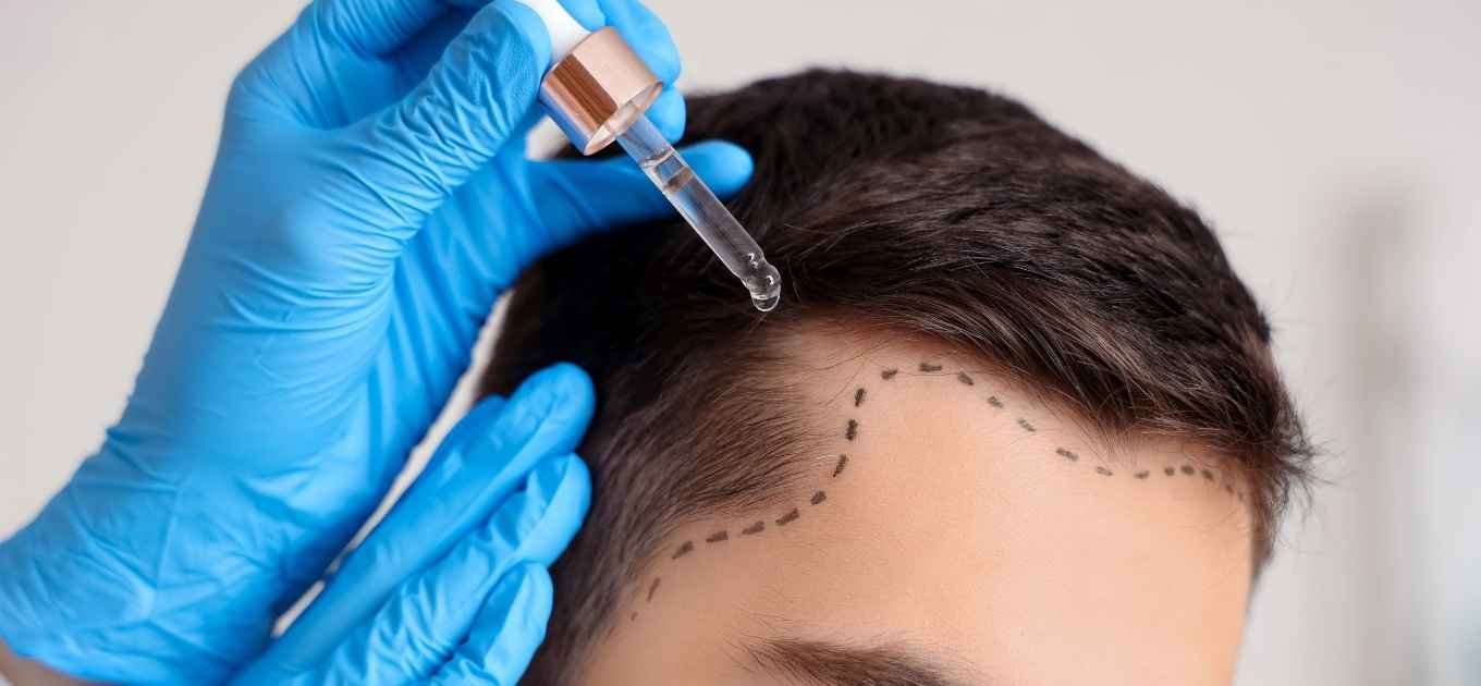 homme ayant un début de calvitie se fait appliquer un traitement anti-chute par un professionnel