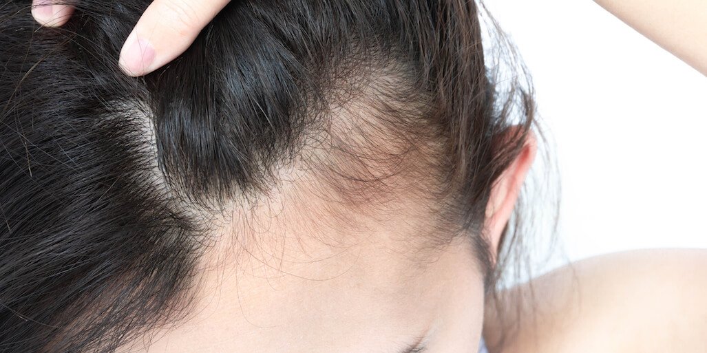 comment-freiner-la-chute-des-cheveux-chez-l-adulte