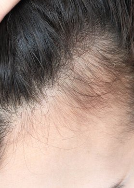 comment-freiner-la-chute-des-cheveux-chez-l-adulte