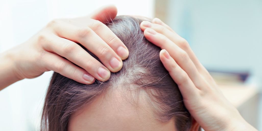 perte de cheveux chez la femme : que faire ?