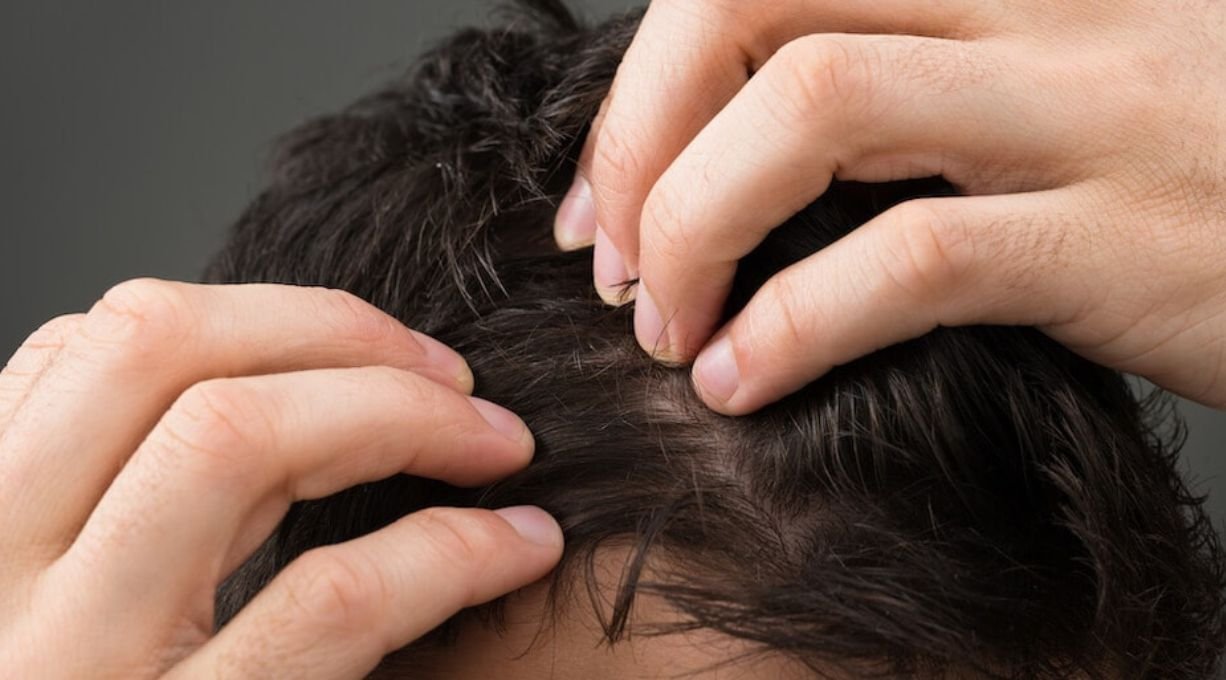 éliminer efficacement les pellicules