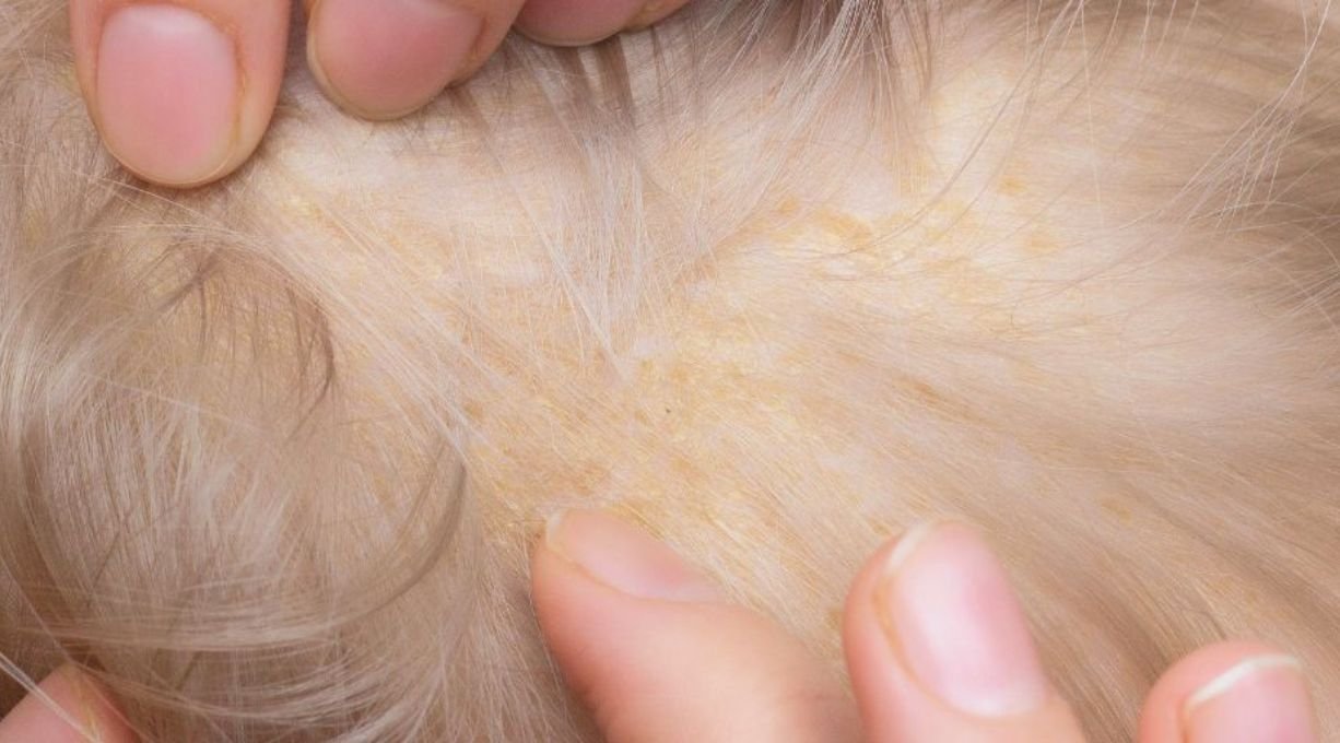 dermatite du cuir chevelu