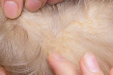 dermatite cuir chevelu : que faire ?