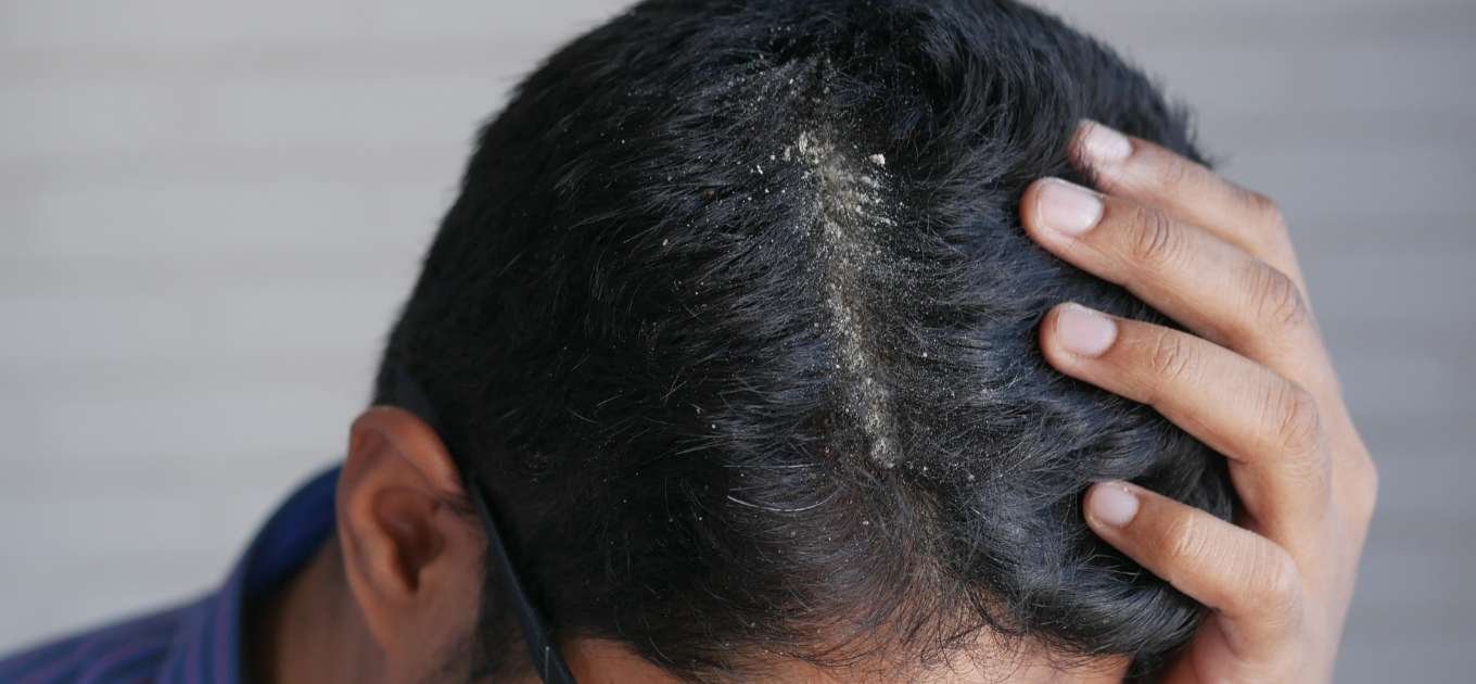 Homme ayant une desquamation du cuir chevelu