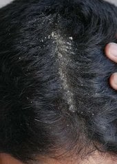 Homme ayant une desquamation du cuir chevelu