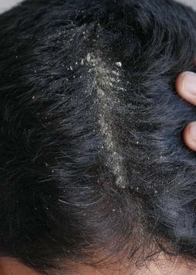 Homme ayant une desquamation du cuir chevelu