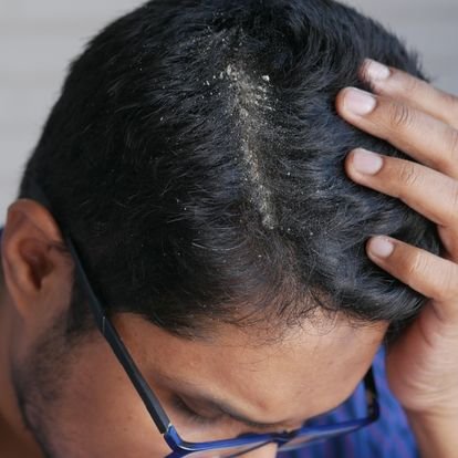Homme ayant une desquamation du cuir chevelu