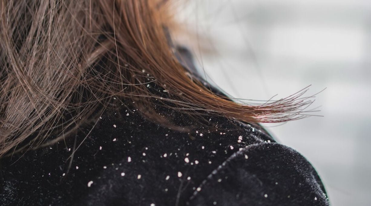 éliminer les pellicules sèches