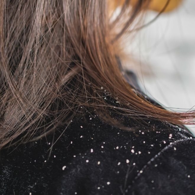 Femme au cheveux mi-longs ayant des pellicules sèches sur les épaules