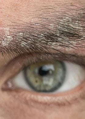pellicules dans les sourcils : que faire ?