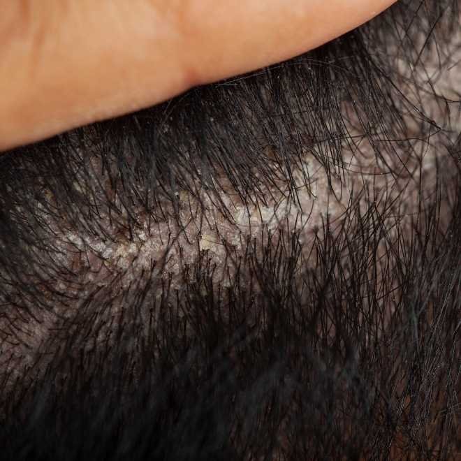 Personne présentant des pellicules grasses sur son cuir chevelu