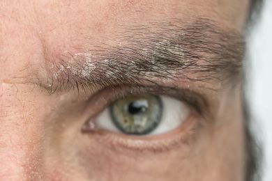 pellilcules dans les sourcils : que faire ?