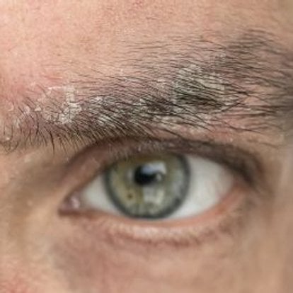 pellilcules dans les sourcils : que faire ?