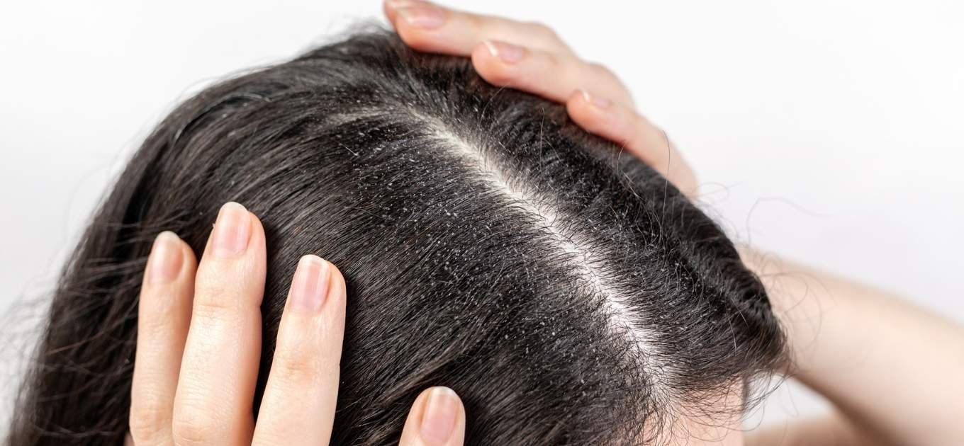 raisons causes pellicules