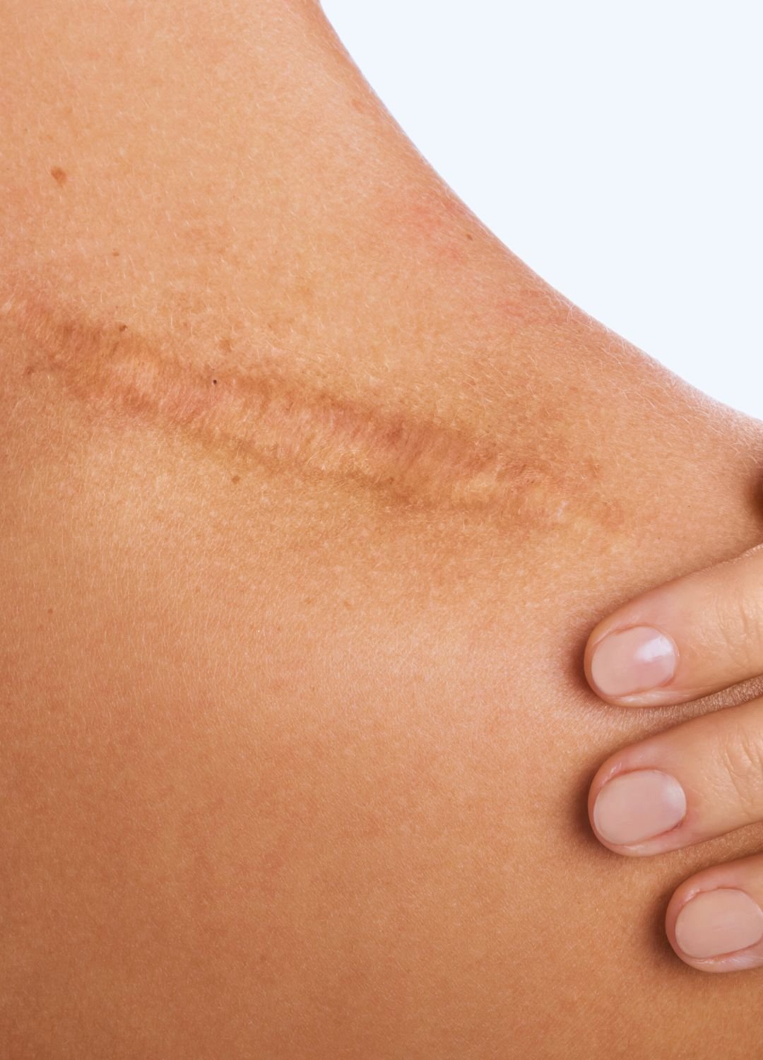 Femme ayant une cicatrice sur l'épaule