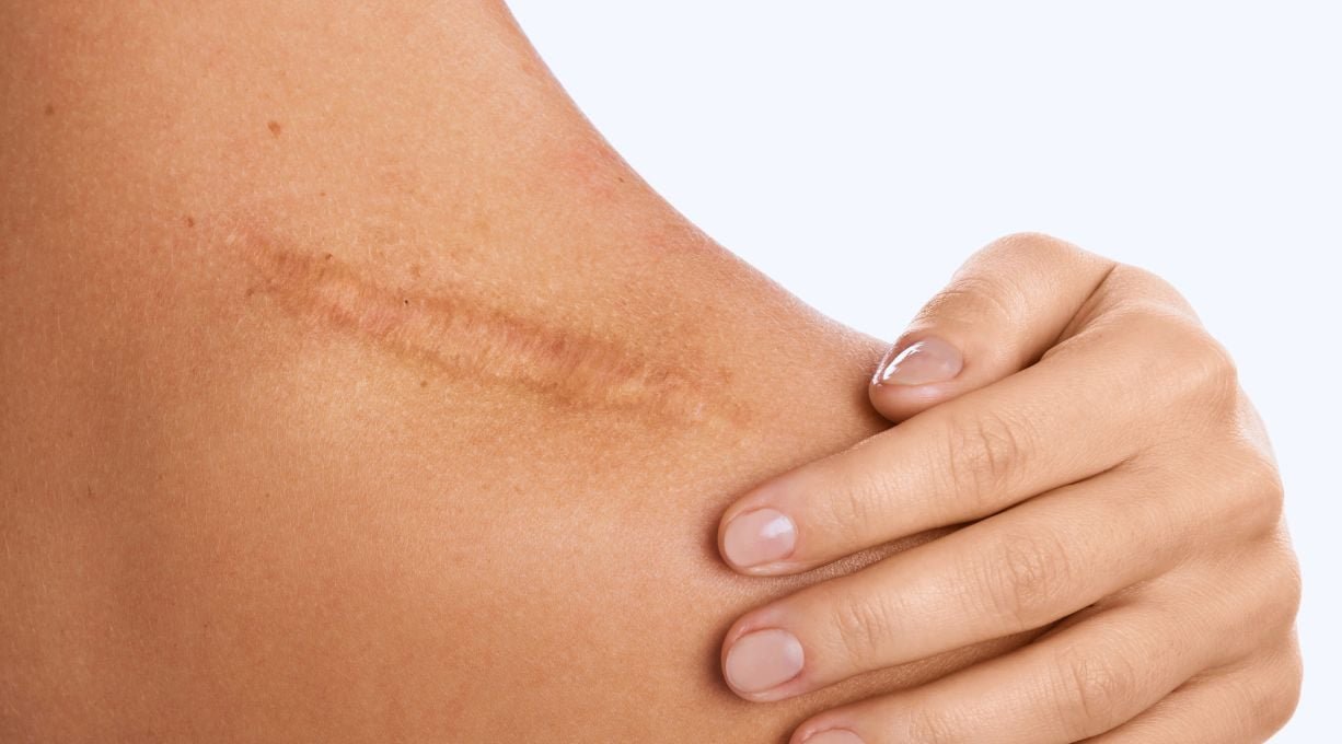 Femme ayant une cicatrice sur l'épaule