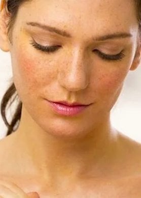 depigmentation-peau