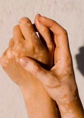 Que faire pour effacer une tache orange sur les mains ? | VICHY