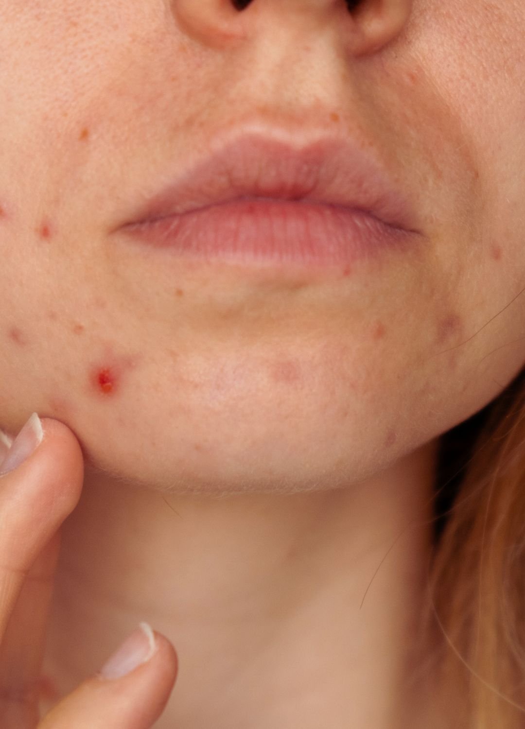 masque de grossesse autour de la bouche