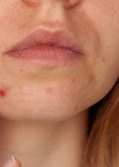 masque de grossesse autour de la bouche