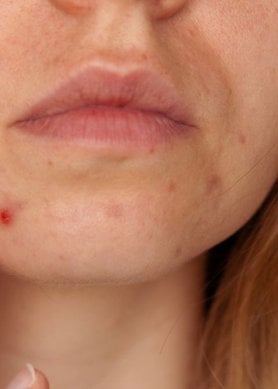 masque de grossesse autour de la bouche