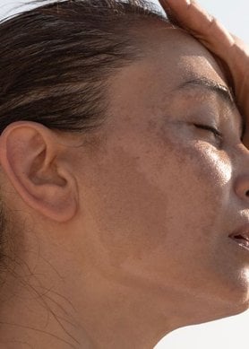 Mélasma visage